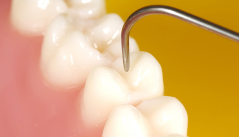 Selante: o dente blindado contra o perigo da doença cárie Selante: o dente blindado contra o perigo da doença cárie